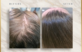 Hair Restoration