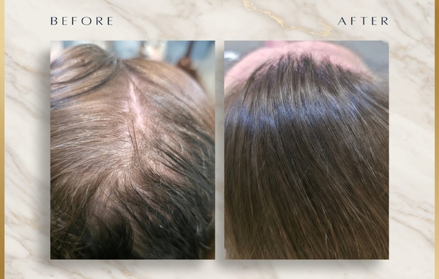Hair Restoration